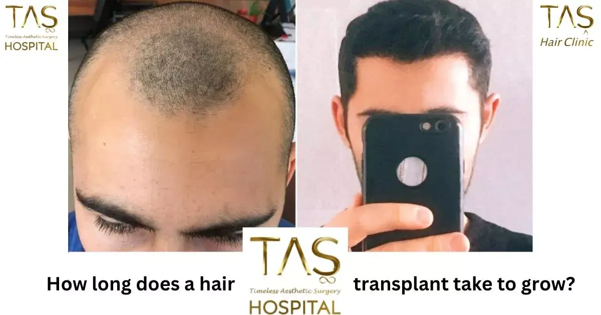 How Long Does It Take For Hair Transplant Results? - TAŞ Hair Clinic