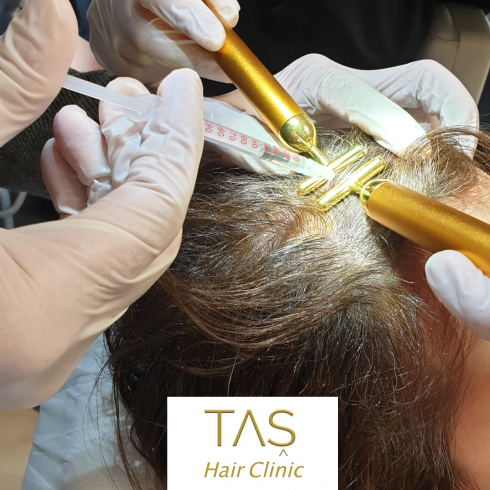 hair mesotherapy for female patient