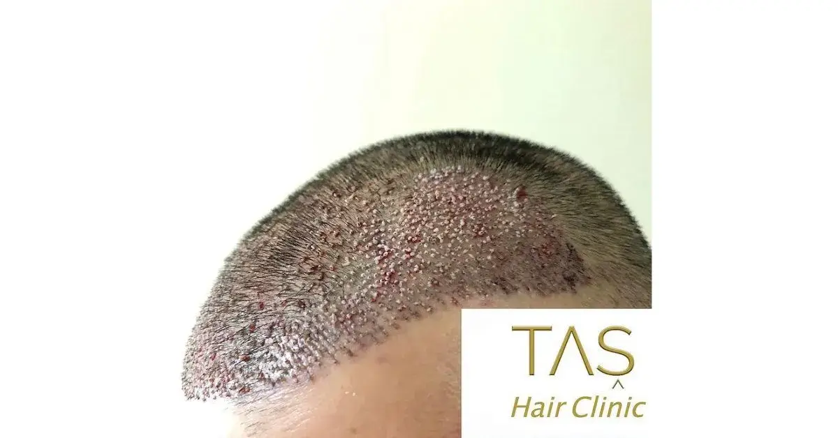 Hair Transplant Scab - TAŞ Hair Clinic