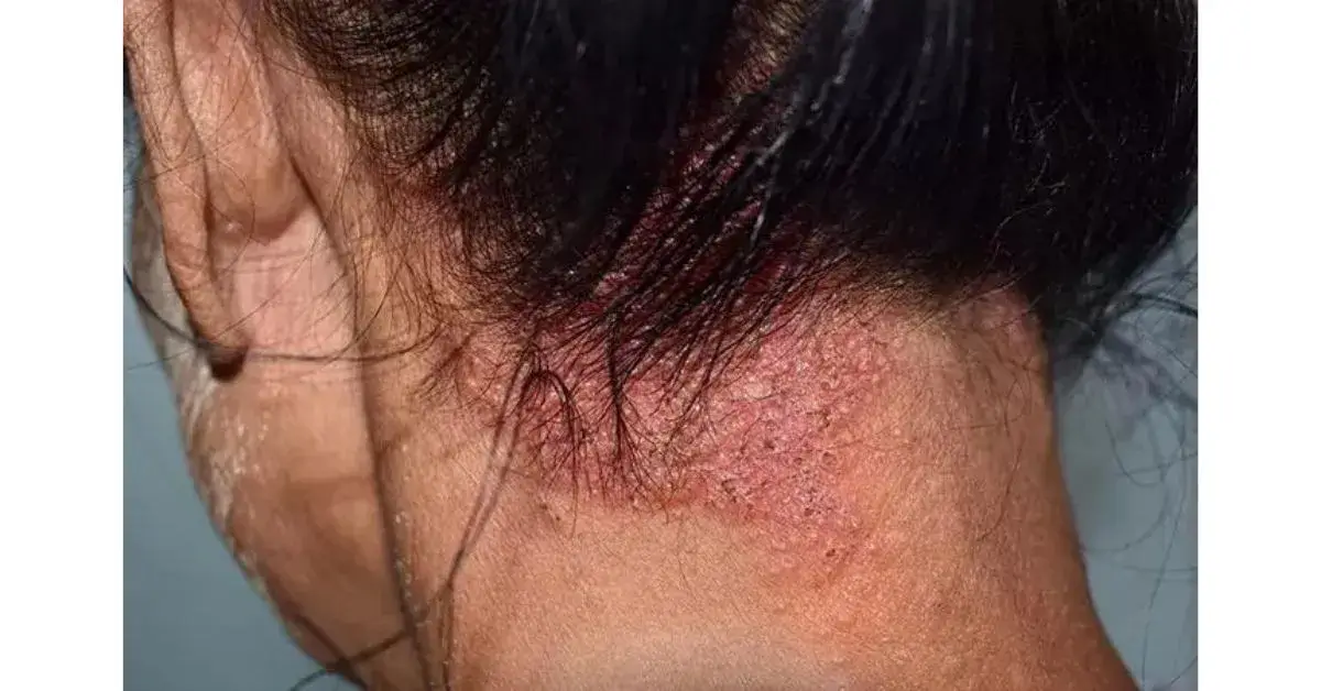 Scalp fungal infection