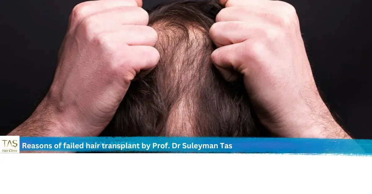 Failled hair transplant
