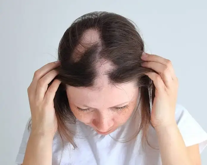 Patchy hair loss in women