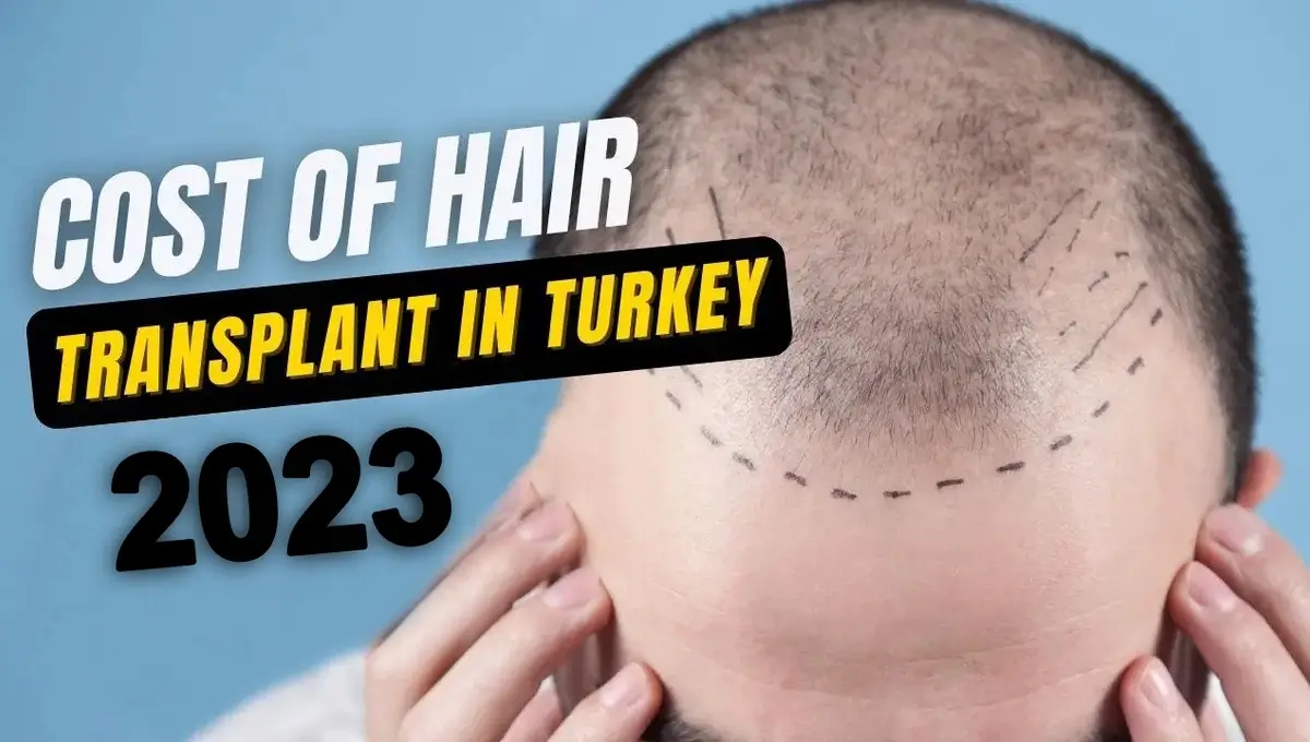 cost of hair transplant in 2023