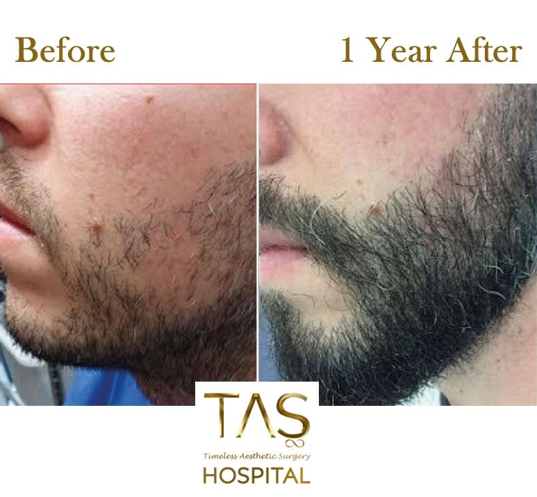 Beard Transplant Turkey Tas Hair Clinic