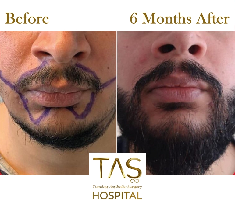 Beard Transplant Turkey Tas Hair Clinic