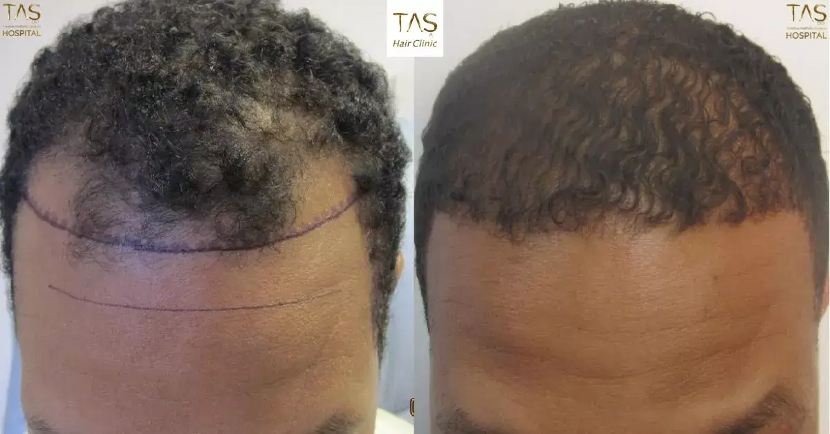 African american hair transplant